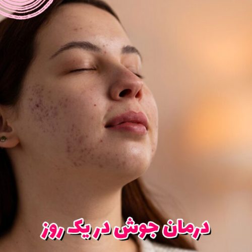 درمان جوش در یک روز