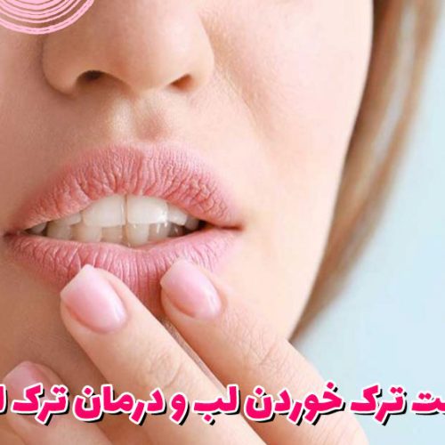 علت ترک خوردن لب و درمان ترک لب