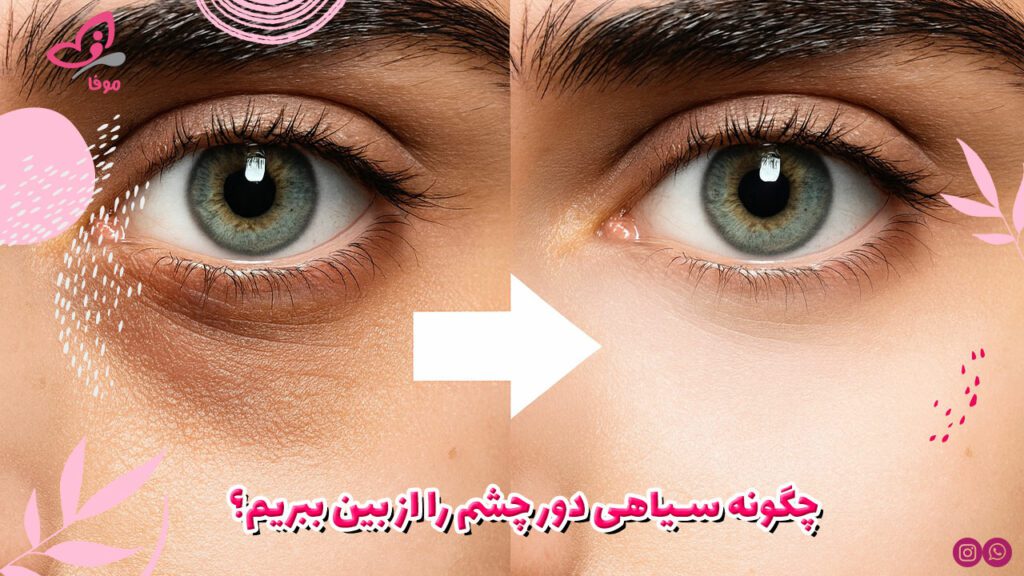 چگونه سیاهی دور چشم را از بین ببریم؟