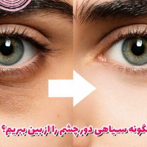 چگونه سیاهی دور چشم را از بین ببریم؟