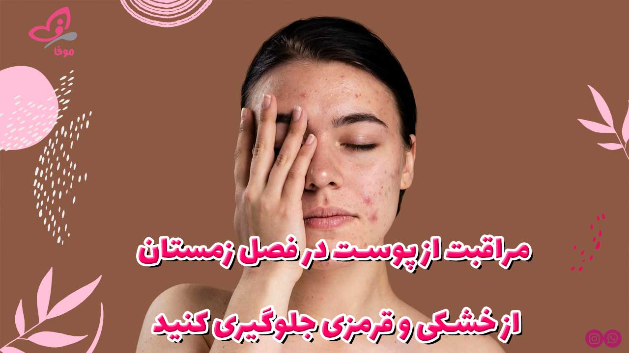 مراقبت از پوست در فصل زمستان: از خشکی و قرمزی جلوگیری کنید