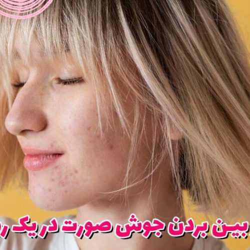 از بین بردن جوش صورت در یک روز