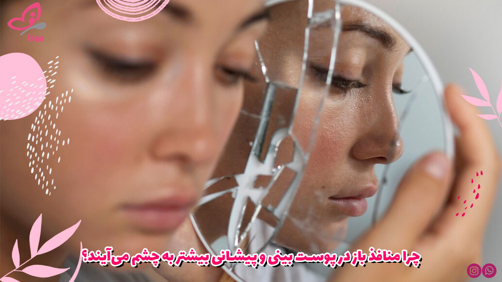 چرا منافذ باز در پوست بینی و پیشانی بیشتر به چشم می‌آیند؟
