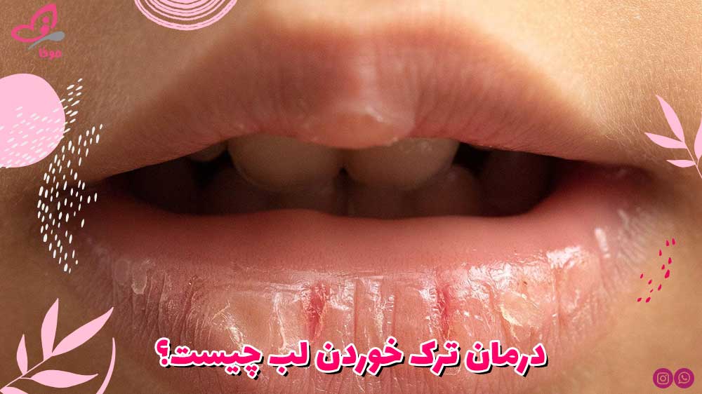 درمان ترک خوردن لب چیست؟