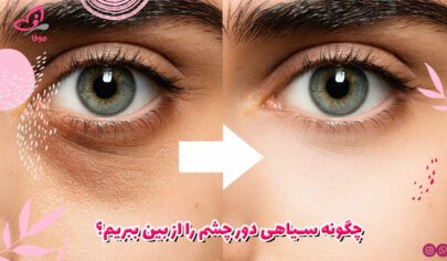 چگونه سیاهی دور چشم را از بین ببریم؟